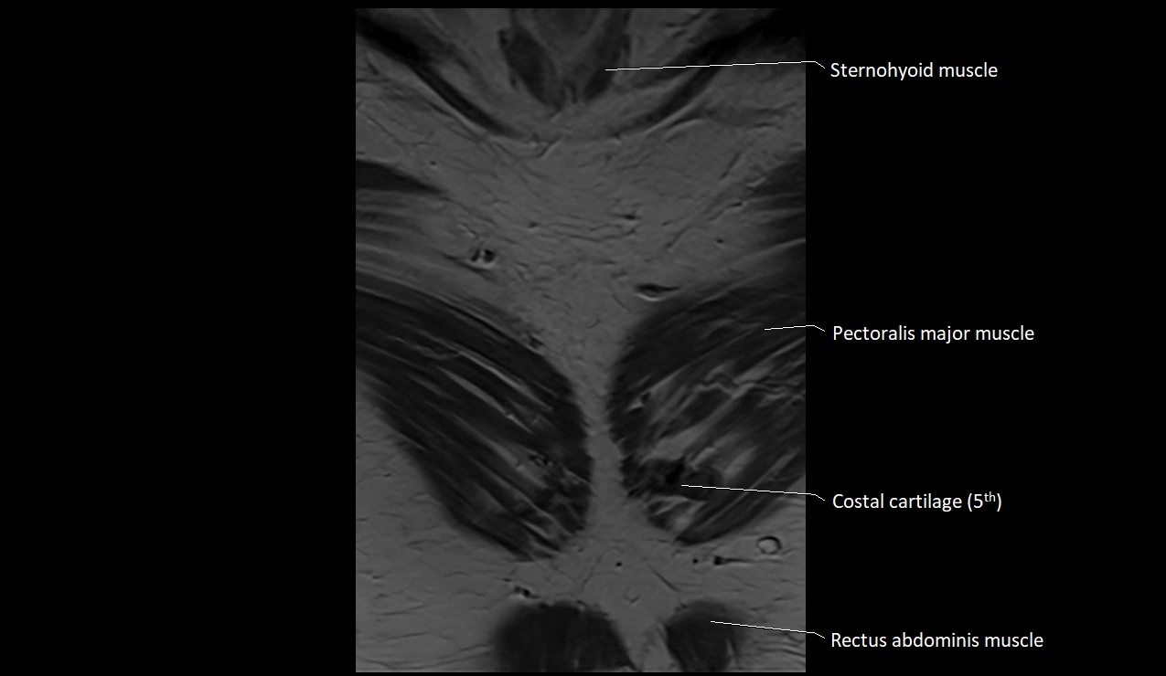 MRI sternum and sternoclavicular joint labeled coronal anatomy image 3.webp